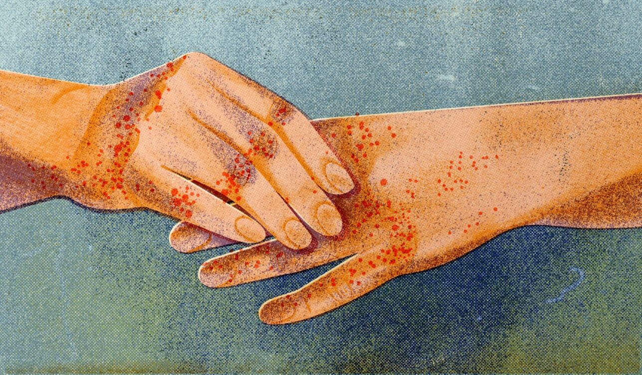 Контактный дерматит: как лечить и предотвратить